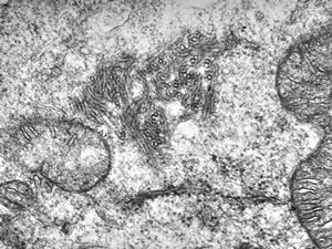 M,18y. | blood - tubular inclusions in lymphocytes